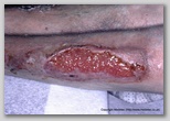 wound image