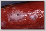 wound image