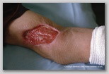 wound image