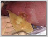 wound image