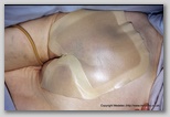 wound image