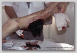 wound image
