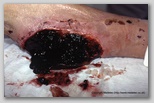 wound image