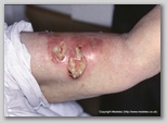 wound image