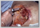 wound image