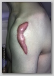 wound image