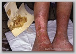 wound image