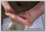 wound image