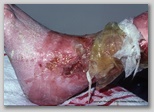 wound image