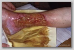 wound image