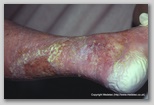 wound image