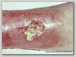 wound image