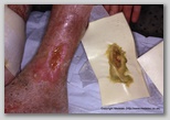 wound image