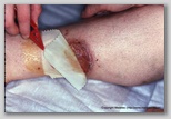 wound image