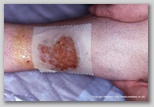wound image