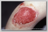 wound image