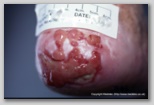 wound image