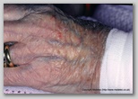wound image