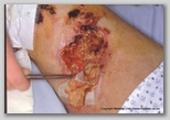 wound image