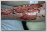 wound image
