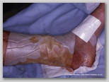 wound image