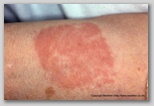 wound image