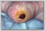 wound image