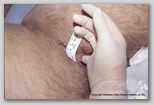 wound image
