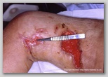 wound image