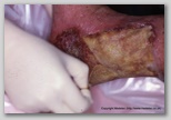 wound image