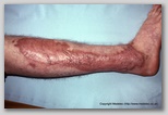wound image