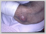 wound image