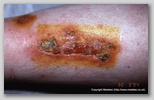 wound image