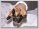 wound image