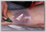 wound image