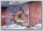 wound image