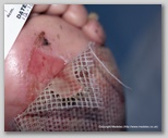 wound image