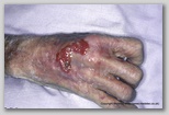 wound image