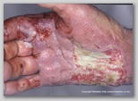 wound image