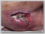 pressure ulcer