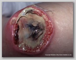 pressure ulcer