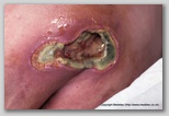 pressure ulcer