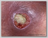 pressure ulcer