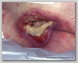 pressure ulcer