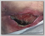 pressure ulcer