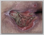 pressure ulcer