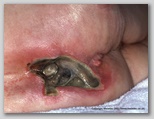 pressure ulcer