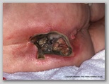 pressure ulcer