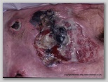 pressure ulcer