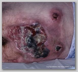 pressure ulcer